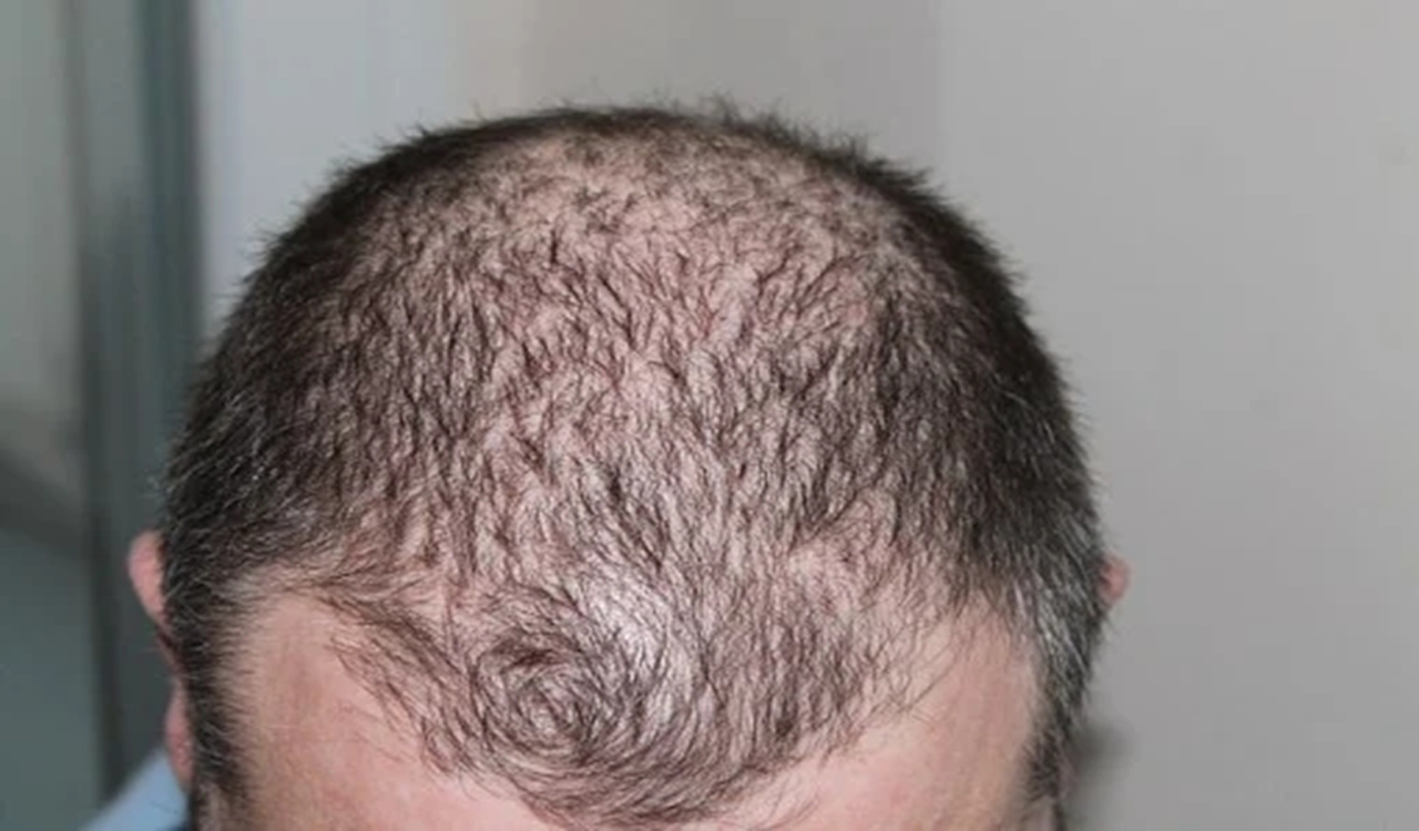 Rare gene variants causing hereditary hair loss in men identified