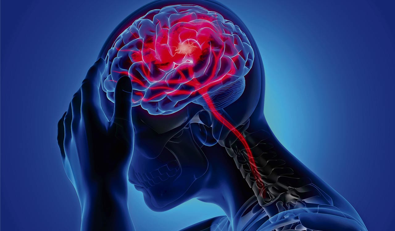 Early intervention can help brain stroke patients