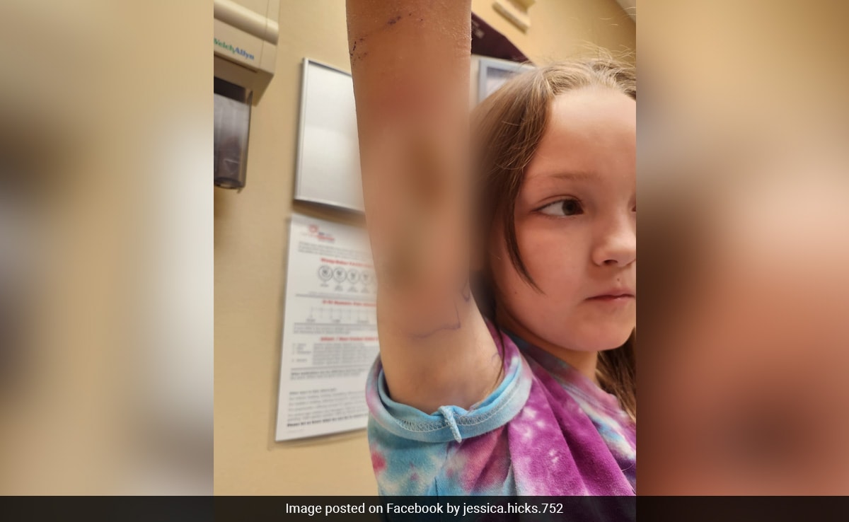 Girl, 9, Complains Of Pinch. Then Mother Finds "Terrifying" Spider Bite