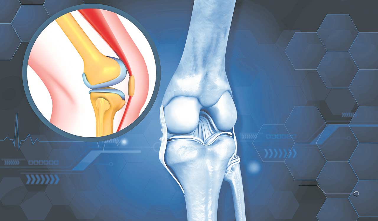 India: Knee implants, replacement to cost more