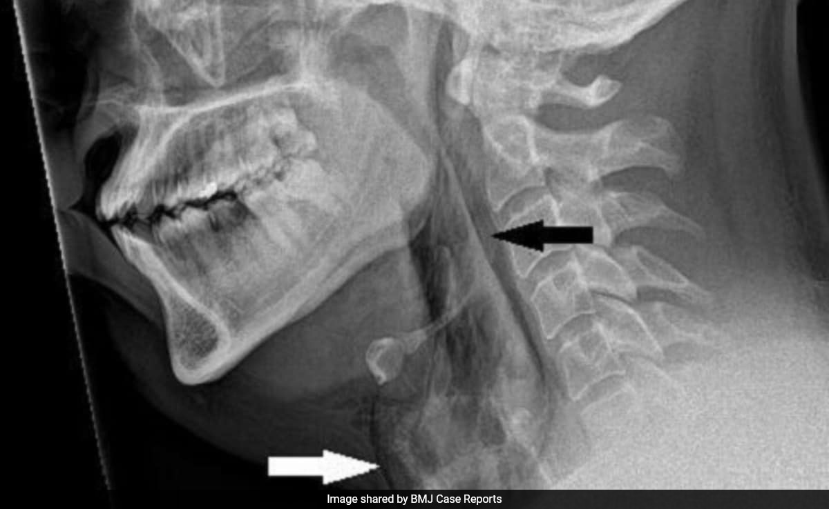 In A Rare First, Man Tears Windpipe From Holding His Sneeze