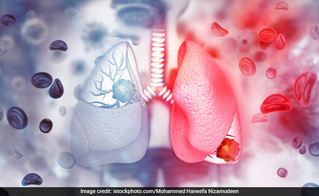 What Is White Lung Syndrome? A Mysterious Pneumonia Outbreak, Similar To China's