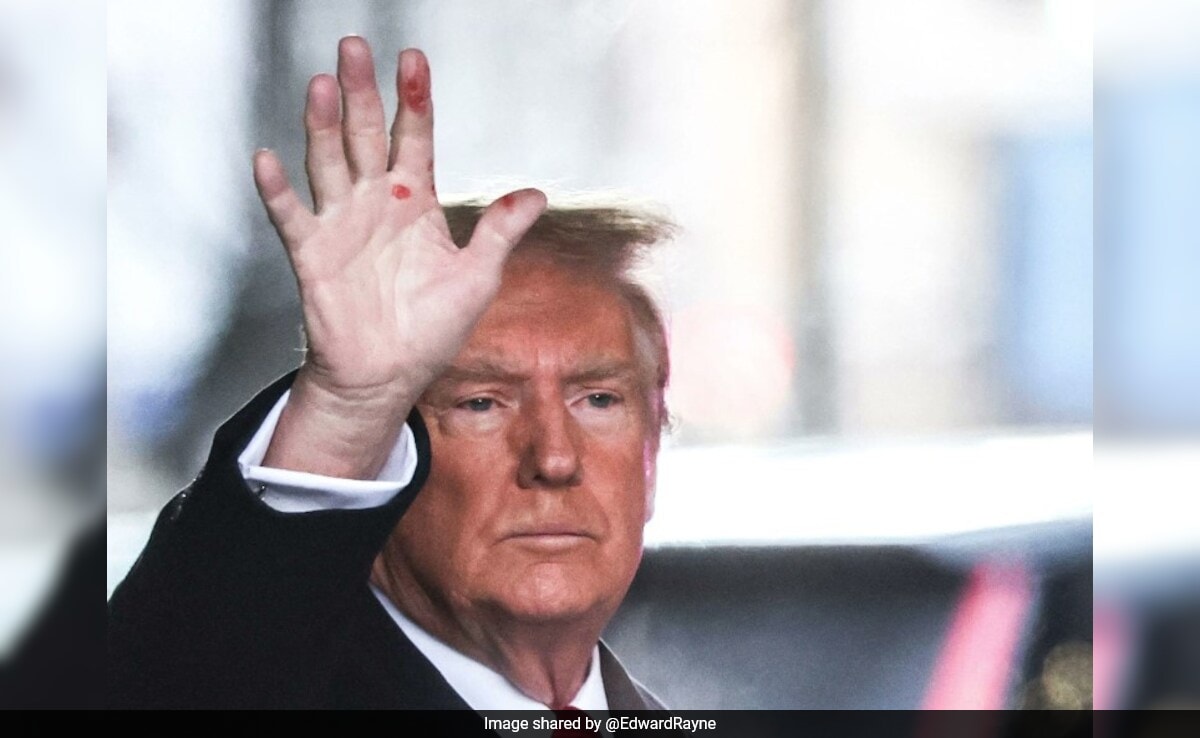 Red Spots On Donald Trump's Hand In Viral Pic Spark Speculation