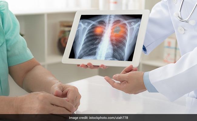 Indians Suffering More From Post-Covid Lung Damage: Study