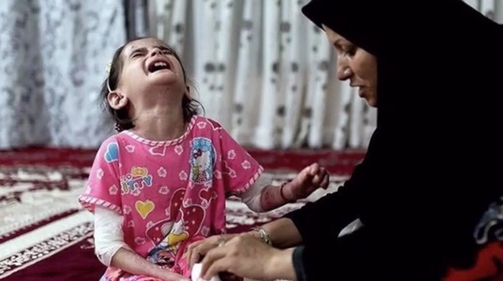 Iran produces wound dressings for butterfly children amid US sanctions