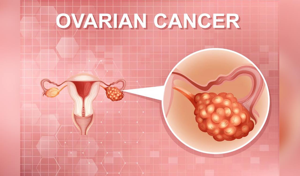 New method may detect early ovarian cancer from urine test