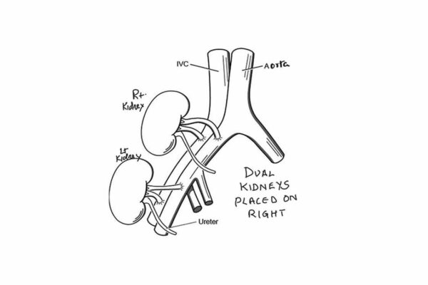 AIIMS Delhi performs first dual kidney transplant of 78-year-old woman