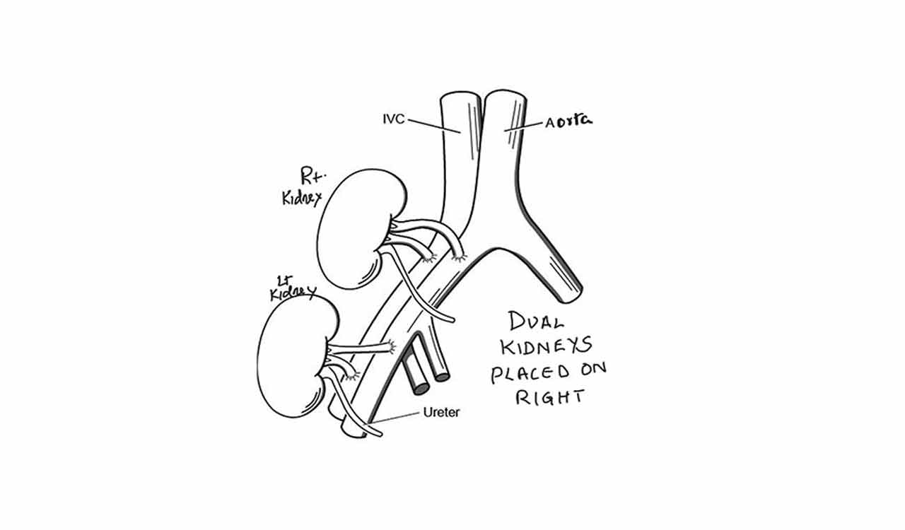 AIIMS Delhi performs first dual kidney transplant of 78-year-old woman