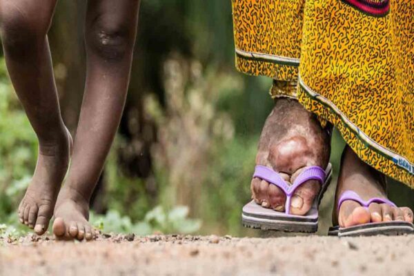 UP makes progress in elimination of lymphatic filariasis