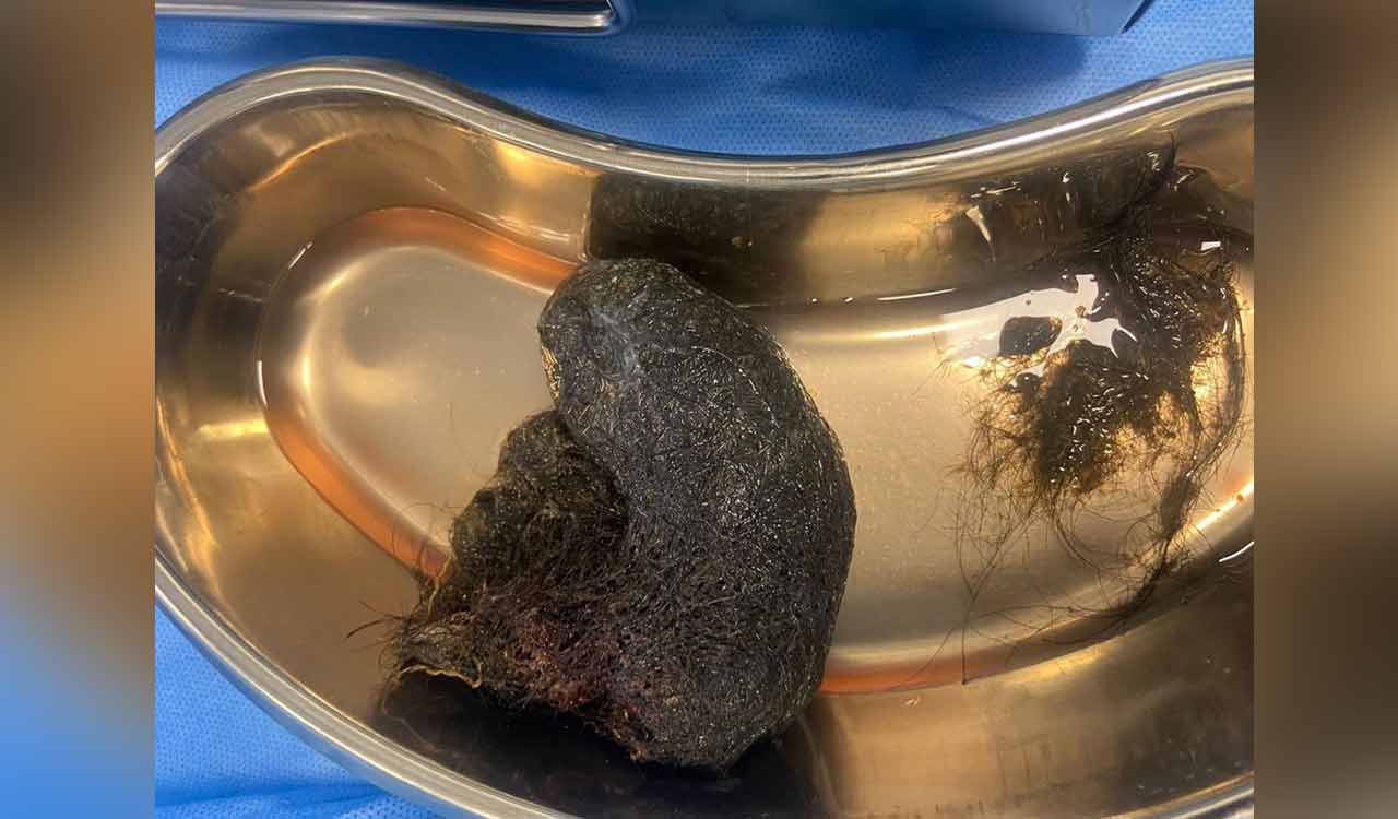 Bengaluru doctors remove cricket ball-sized hairball from 8-year-old’s stomach