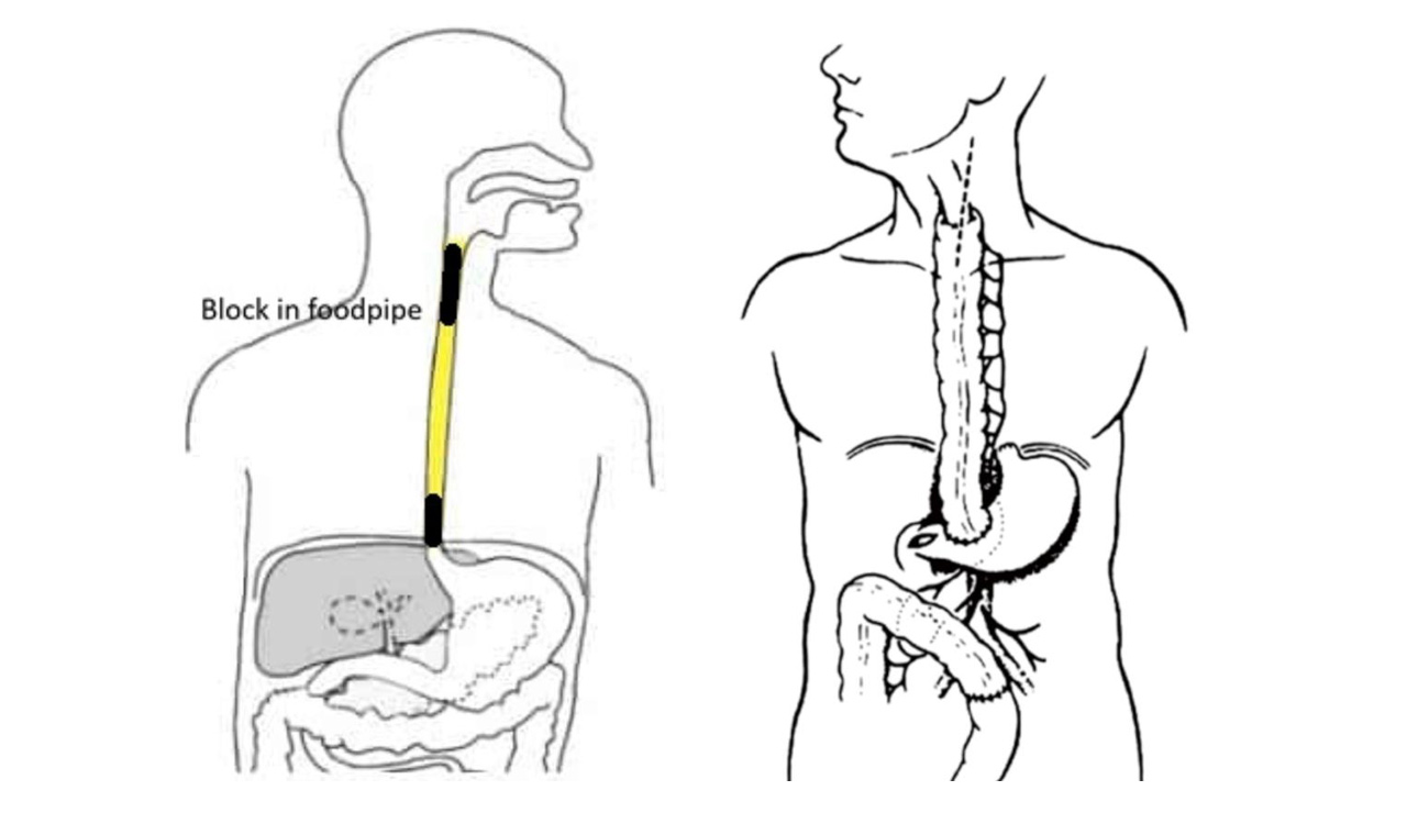 13-year-old undergoes successful oesophageal reconstruction surgery at NIMS Hyderabad