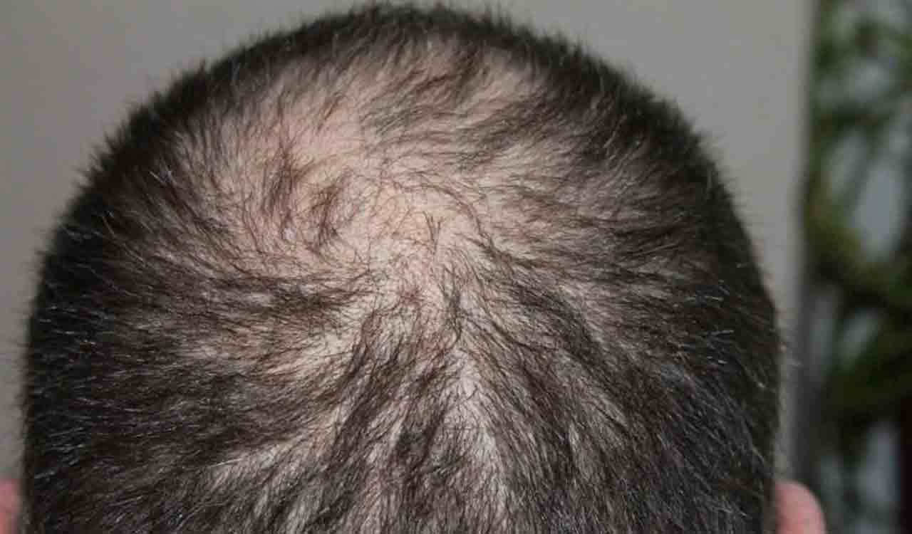 Dermatologists warn of ‘Ozempic Hair’ linked to rapid weight loss
